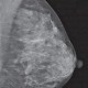 Mammographien regelrecht erstellen