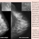 Mammographie-Screening senkt Brustkrebssterberisiko