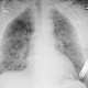 Lungenödem nach Inhalation von Salpetersäure