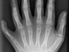 polydactyly_01_lhand_ap1