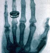 170px-X-ray_by_Wilhelm_Röntgen_of_Albert_von_Kölliker's_hand_-_18960123-02