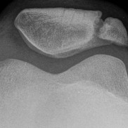 Patella_bipartita