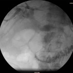 Mit einem  gebogenen Führungsdraht gelingt die Passage durch den Tumor in den Dünndarm.