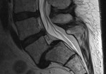 MR_LWS_Spondylolistesis_Rueckenmarkskanal