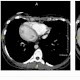 Situs inversus