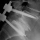 Spondylolisthesis (Wirbelgleiten)