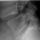 Spondylolisthesis (Wirbelgleiten)