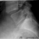 Spondylolisthesis (Wirbelgleiten)