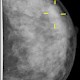Wiederholende MR-Mammografie liefert weniger falsch positive Befunde
