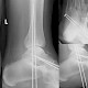 Calcaneus-Luxation