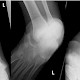 Calcaneus-Luxation