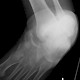 Calcaneus-Luxation