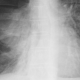 Spontanpneumothorax