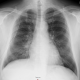 Spontanpneumothorax