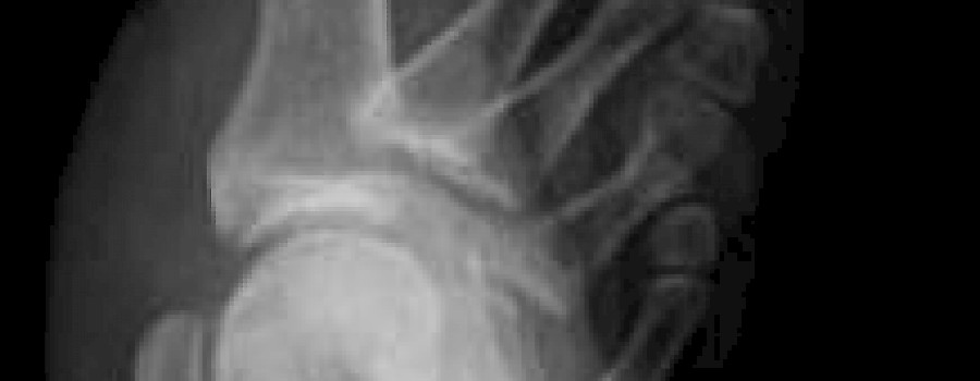 Brachydaktylie (Kurzfingrigkeit) MTAR.de