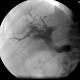 PTCD - Perkutane transhepatische Cholangiodrainage