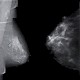 Die Mammographie (Teil 3)