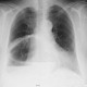 Thorax-Magen bzw. Upside-Down-Magen