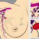 Sentinel-Lymph-Nodes beim Mammakarzinom (Teil 3)