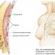 Sentinel-Lymph-Nodes beim Mammakarzinom (Teil 2)