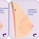 Sentinel-Lymph-Nodes beim Mammakarzinom (Teil 2)