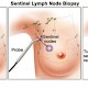 Sentinel-Lymph-Nodes beim Mammakarzinom (Teil 2)