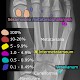 Akzessorische Fußwurzelknochen beim Menschen