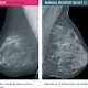 Kriterien für regelgerechte Mammographien