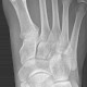 Os tibiale externum