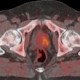 PET-CT mittels 18-FECH (Fluorethylcholin) bei Prostata-Ca