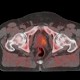 PET-CT mittels 18-FECH (Fluorethylcholin) bei Prostata-Ca