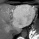 Fokale noduläre Hyperplasie (FNH)