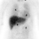 Tumorszintigraphie mit 123-J-mIBG